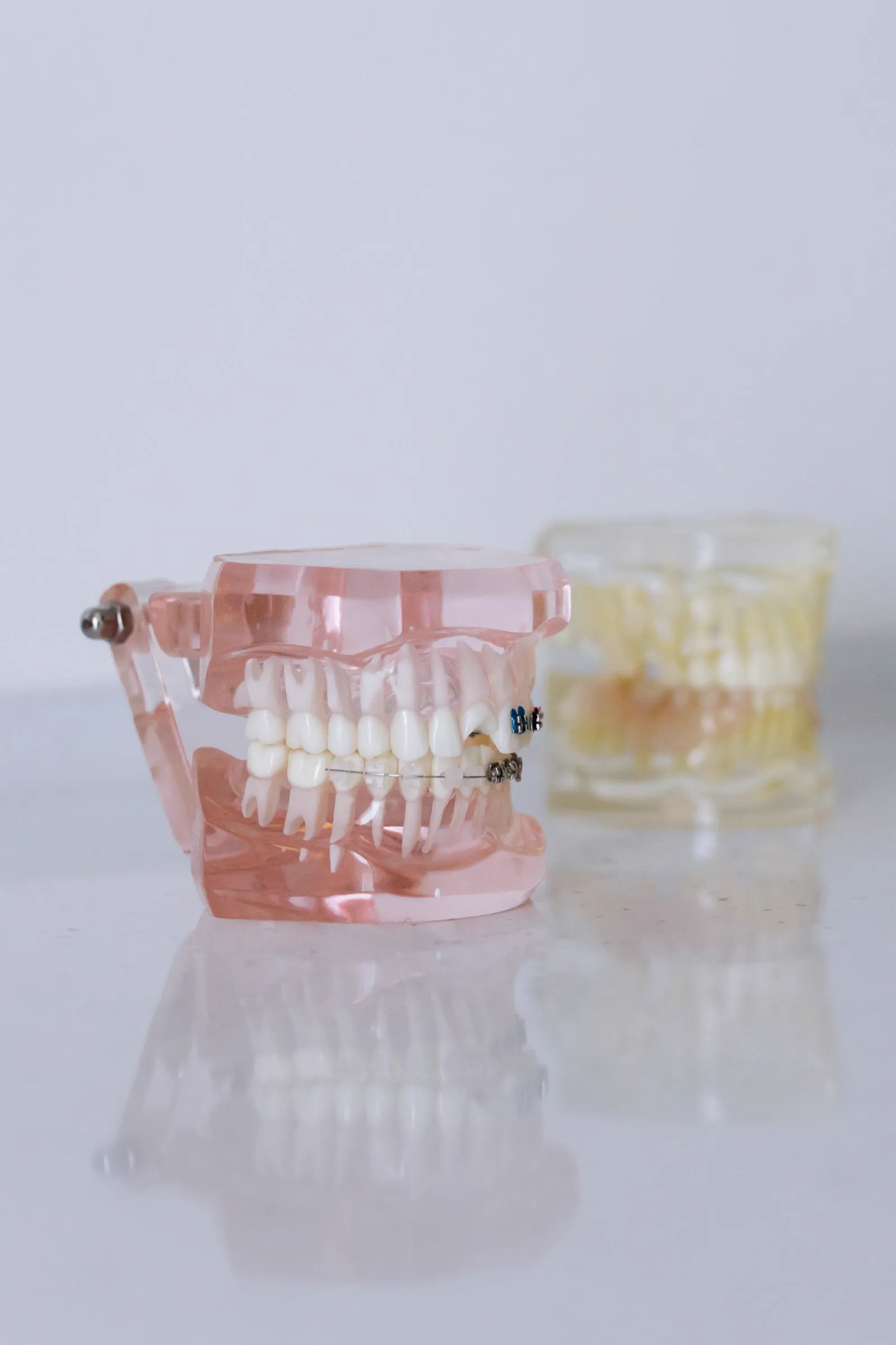 Prothèse dentaire en gros plan, utilisée pour remplacer des dents manquantes