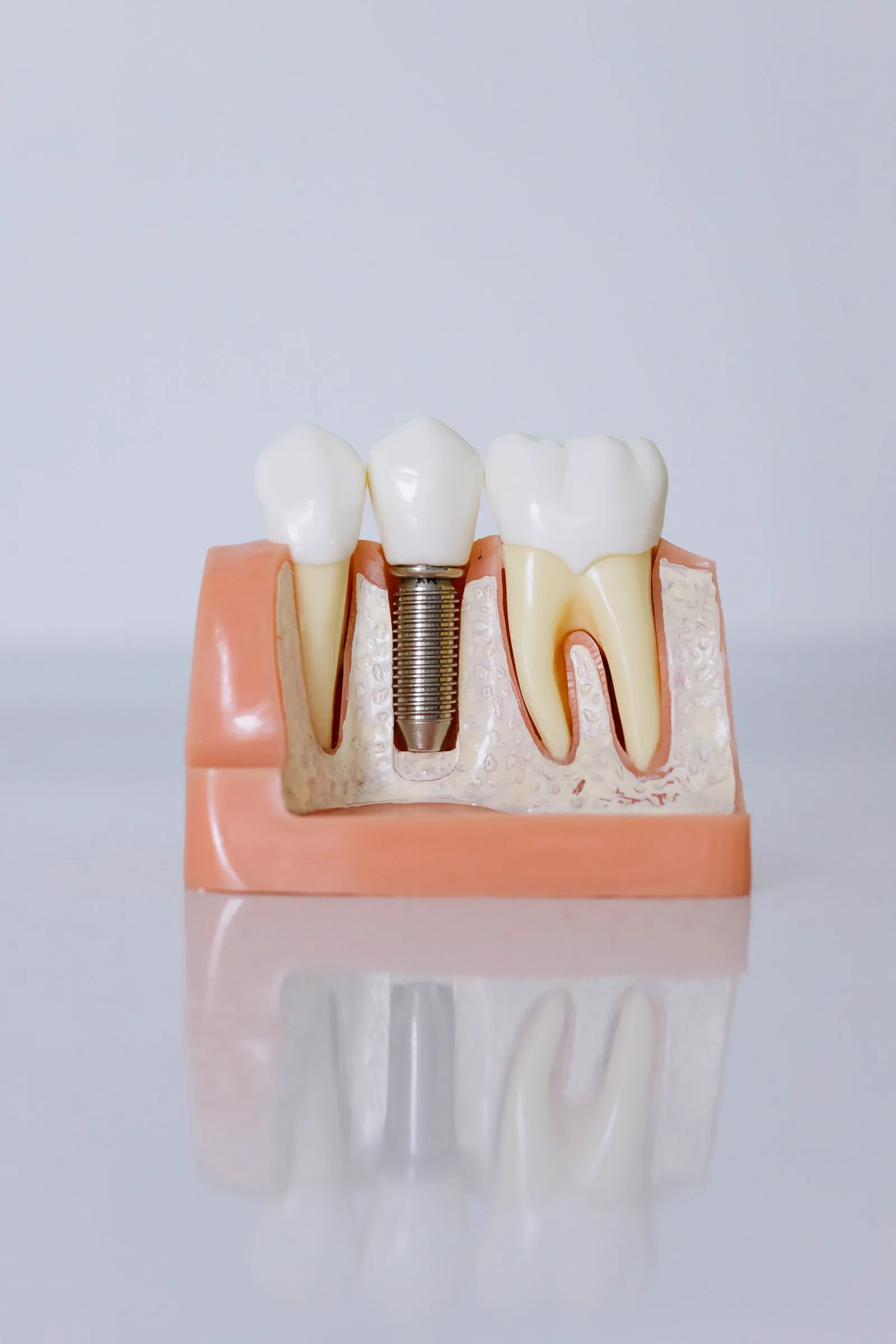 Modèle d'implant dentaire utilisé pour expliquer le traitement